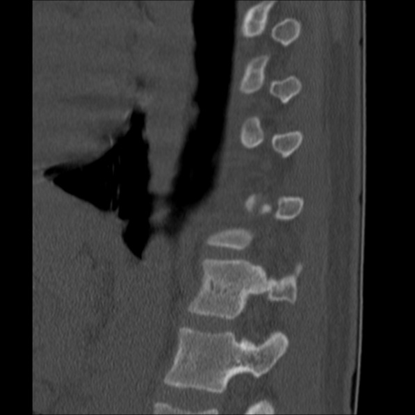 Chance fracture (Radiopaedia 36521-38081 Sagittal bone window 53).jpg