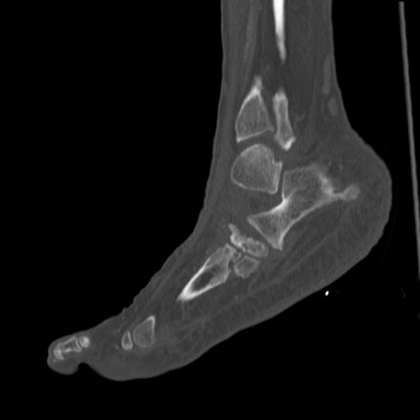 Charcot joint (Radiopaedia 36629-38194 Sagittal bone window 35).jpg