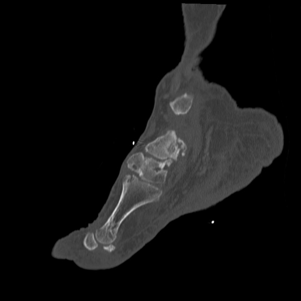 Charcot joint (Radiopaedia 36629-38194 Sagittal bone window 66).jpg