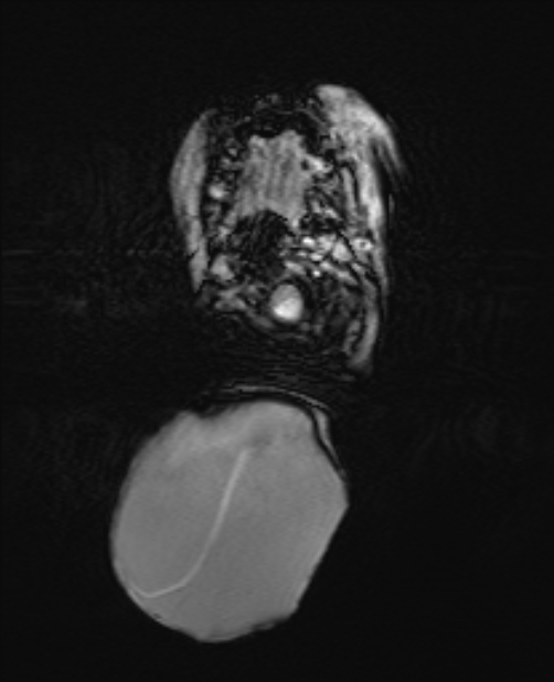 Chiari III malformation with occipital encephalocele (Radiopaedia 79446-92559 Axial SWI 17).jpg