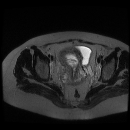 Chiari II malformation - fetal MRI (Radiopaedia 68099-77581 Axial T2-SSFSE 55).jpg