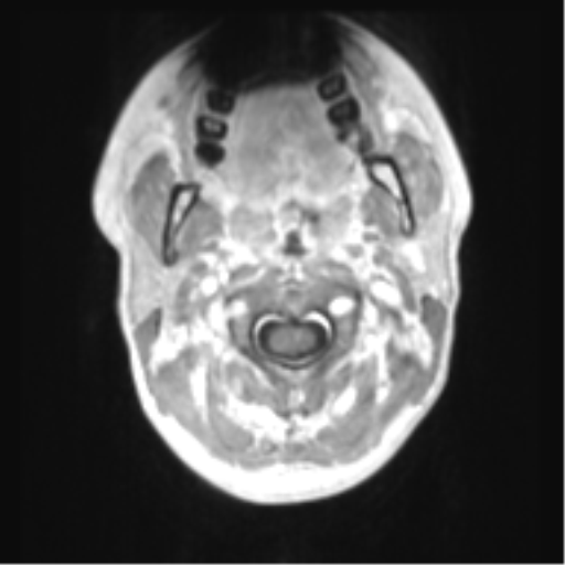 File:Chiari I malformation and obstructive hydrocephalus (Radiopaedia 41185-43978 Axial T1 C+ 1).png