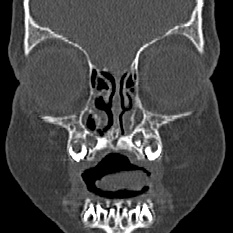 Choanal atresia (Radiopaedia 88525-105975 Coronal bone window 12).jpg