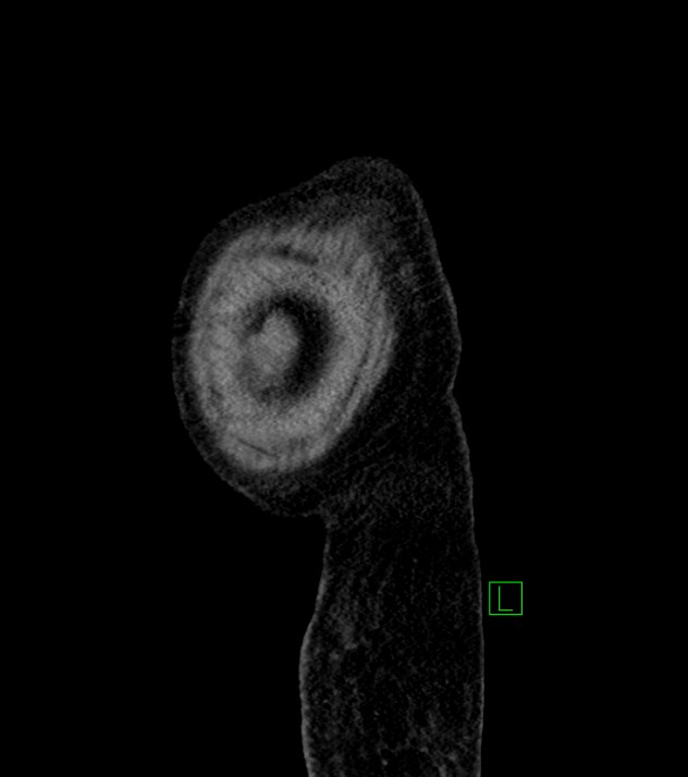 Cholangiocarcinoma with cerebral metastases (Radiopaedia 83519-98629 F 7).jpg