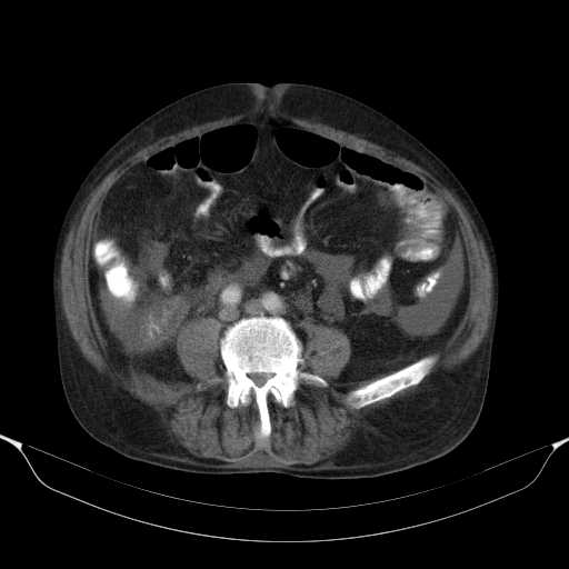 File:Cholangitis and abscess formation in a patient with cholangiocarcinoma (Radiopaedia 21194-21100 A 32).jpg