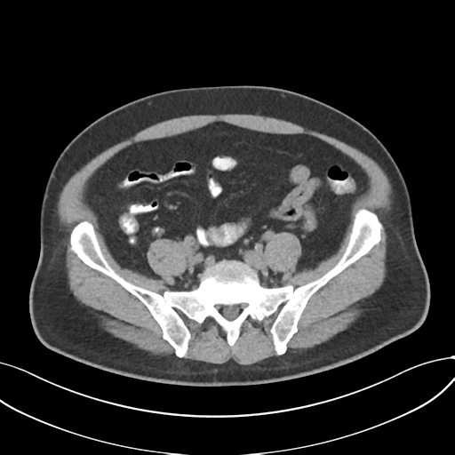 Cholecystitis with focal perforation and hepatic abscess (Radiopaedia 37189-38945 Axial non-contrast 62).png