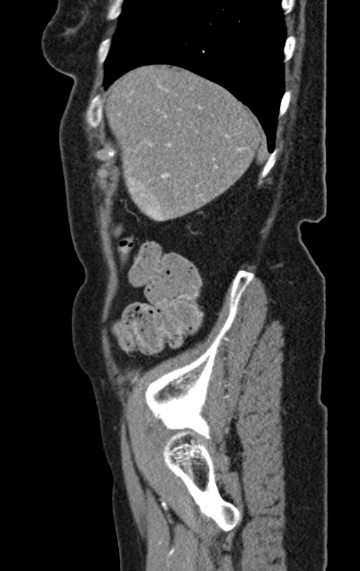 Cholecystoduodenal fistula due to calculous cholecystitis with gallstone migration (Radiopaedia 86875-103077 C 52).jpg