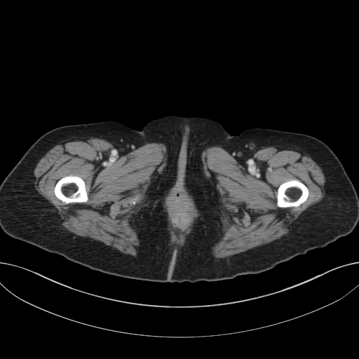 Cholecystoduodenal fistula due to calculous cholecystitis with gallstone migration (Radiopaedia 86875-103077 D 89).jpg