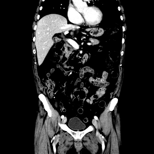 Choledocholiathiasis with normal caliber common bile duct (Radiopaedia 75368-86632 Coronal liver window 56).jpg