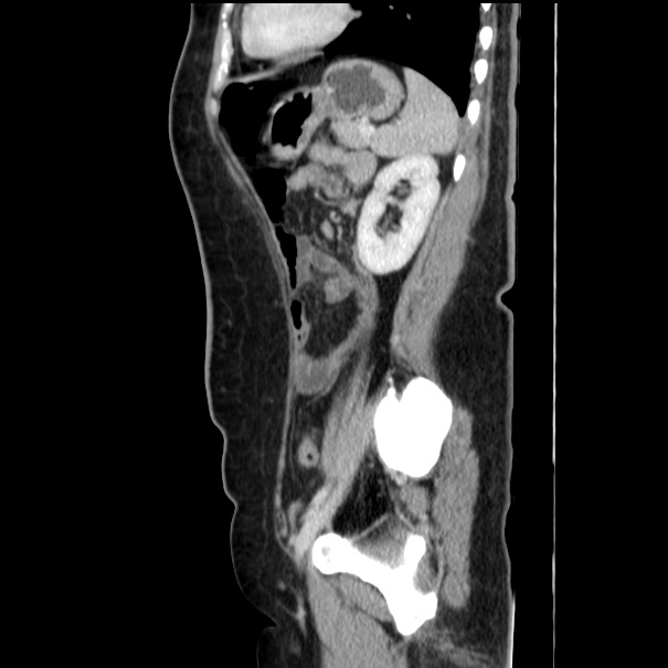 Choledocholithiasis on CT and MRI (Radiopaedia 24825-25087 D 45).jpg