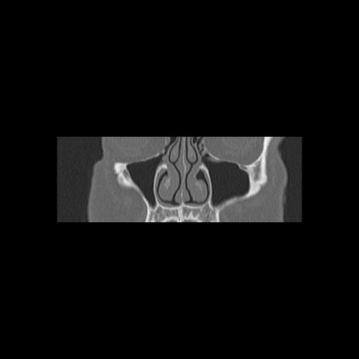Cholesteatoma (Radiopaedia 84946-100455 Coronal bone window 31).jpg