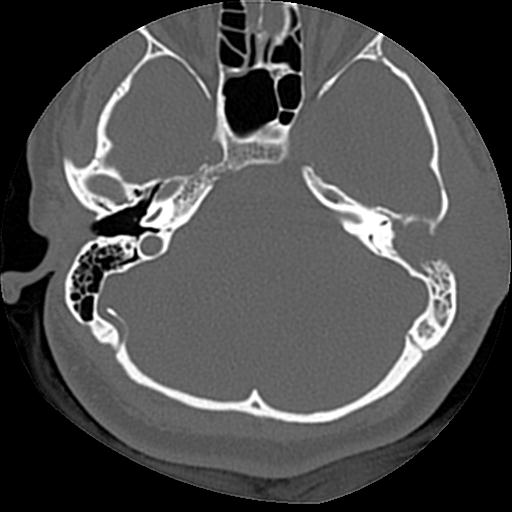 Cholesteatoma (Radiopaedia 84960-100474 Axial bone window 41).jpg