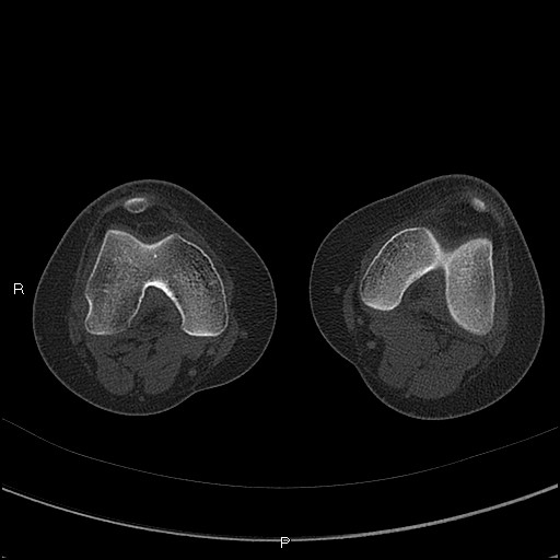 Chondroblastoma (Radiopaedia 62721-71030 Axial bone window 22).jpg