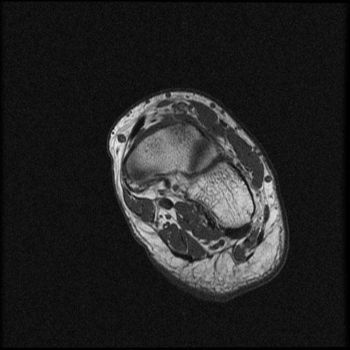 File:Chondroblastoma - midfoot (Radiopaedia 64831-73765 Short axis T1 11).jpg