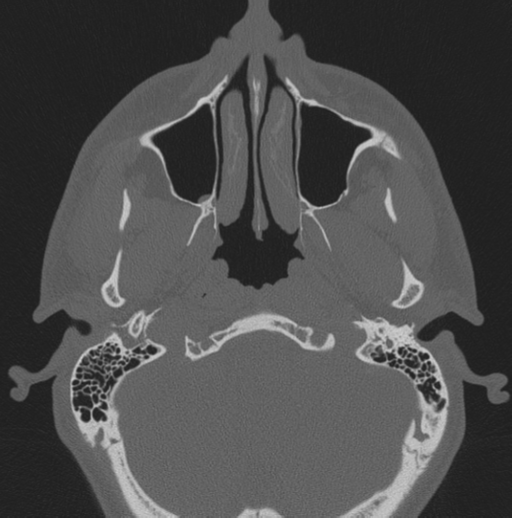 Chondrosarcoma (clivus) (Radiopaedia 46895-51425 Axial bone window 65).png