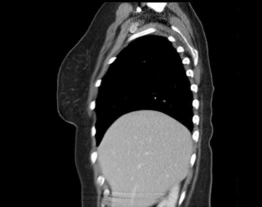 Chondrosarcoma - chest wall (Radiopaedia 65192-74199 B 48).jpg