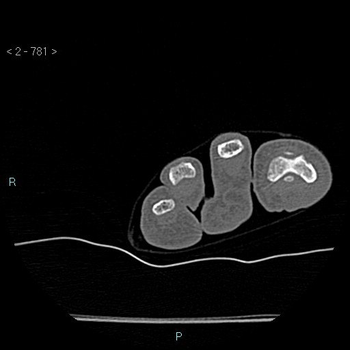 Chondrosarcoma - phalanx (Radiopaedia 69047-78812 Axial bone window 35).jpg