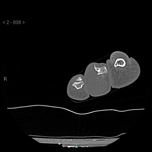 Chondrosarcoma - phalanx (Radiopaedia 69047-78812 Axial bone window 92).jpg
