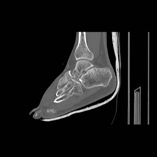 File:Chopart fracture (Radiopaedia 12386-12650 Sagittal bone window 13).jpg