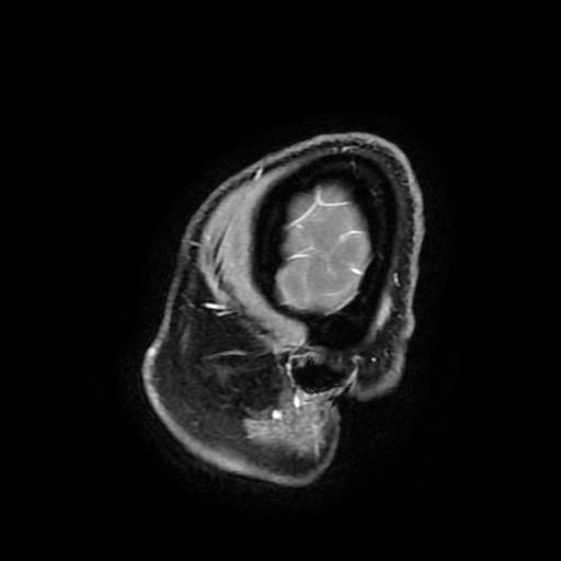 Chordoid glioma of third ventricle (Radiopaedia 91612-109340 F 190).jpg