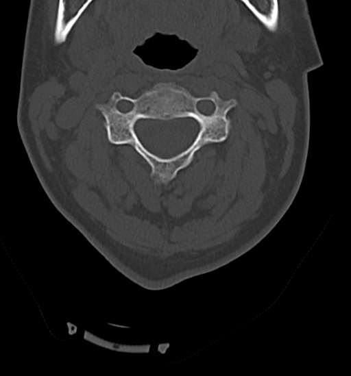 File:Chordoma (C4 vertebra) (Radiopaedia 47561-52188 Axial bone window 19).png