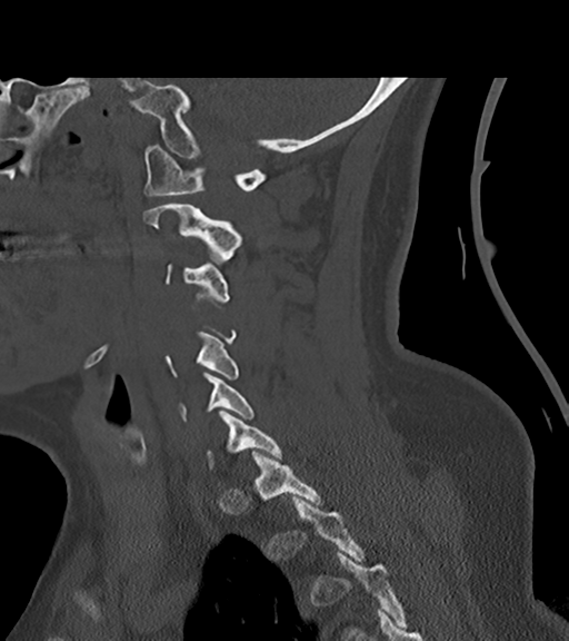 File:Chordoma (C4 vertebra) (Radiopaedia 47561-52188 Sagittal bone window 50).png