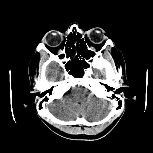 File:Choriocarcinoma of ovary with cerebral and pulmonary metastases (Radiopaedia 25983-26118 C+ arterial phase 22).jpg