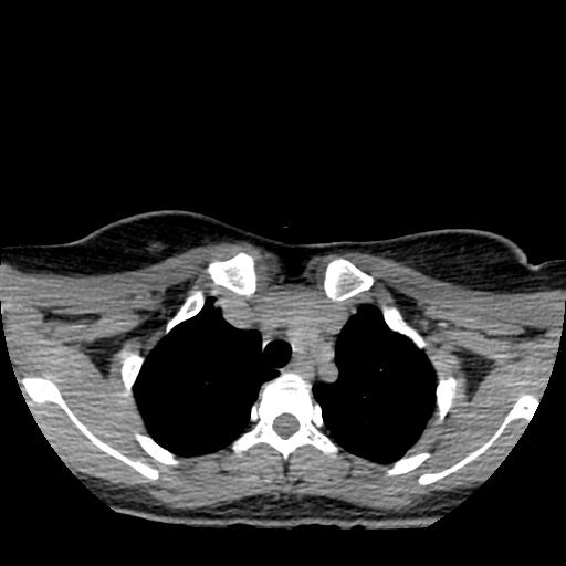 File:Choriocarcinoma of ovary with cerebral and pulmonary metastases (Radiopaedia 25983-26119 Axial non-contrast 91).jpg