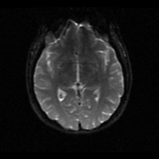 File:Choroid plexus xanthogranuloma (Radiopaedia 17650-17386 ADC 13).jpg