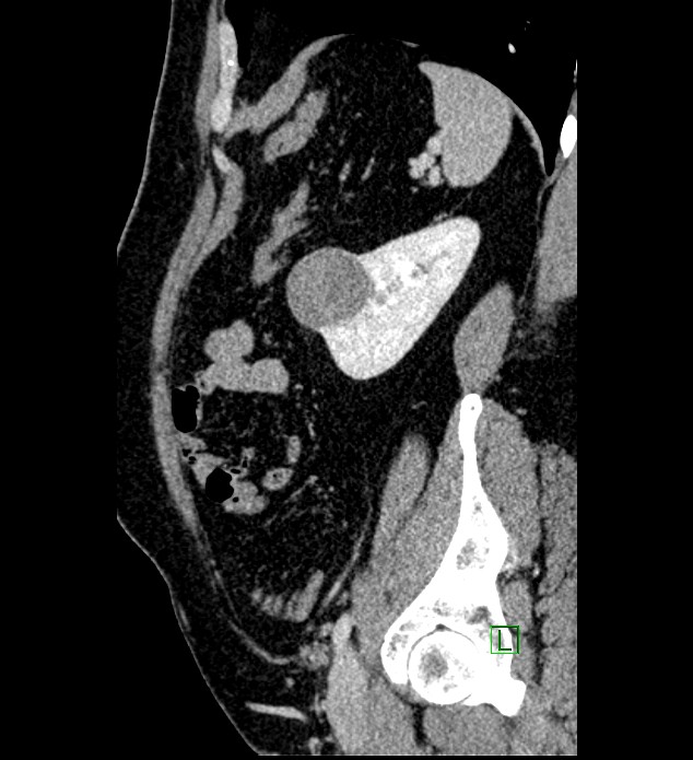 Chromophobe renal cell carcinoma (Radiopaedia 84286-99573 I 44).jpg