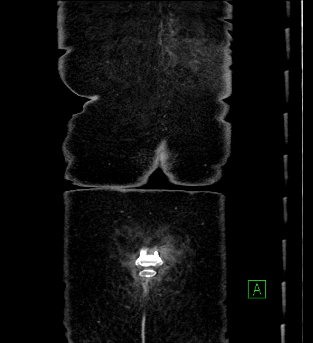 Chromophobe renal cell carcinoma (Radiopaedia 84290-99582 F 69).jpg