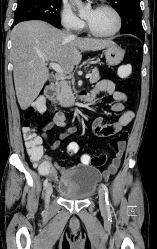 Chronic appendicitis complicated by appendicular abscess, pylephlebitis and liver abscess (Radiopaedia 54483-60700 C 34).jpg