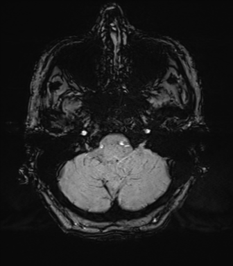 Chronic hypertensive encephalopathy (Radiopaedia 39993-42482 Axial SWI 13).png