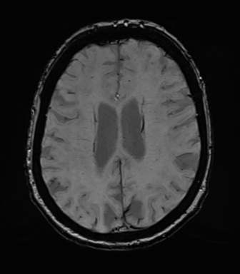 Chronic hypertensive encephalopathy (Radiopaedia 39993-42482 Axial SWI 59).png