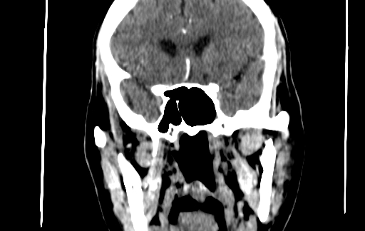 Chronic invasive fungal sinusitis (Radiopaedia 91563-109286 D 90).jpg