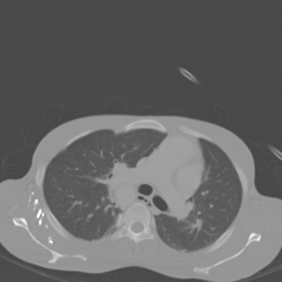Chronic large bowel pseudo-obstruction (Radiopaedia 43181-46492 Axial bone window 5).jpg