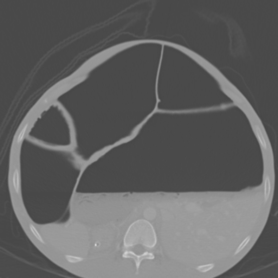 File:Chronic large bowel pseudo-obstruction (Radiopaedia 43181-46492 Axial bone window 60).jpg