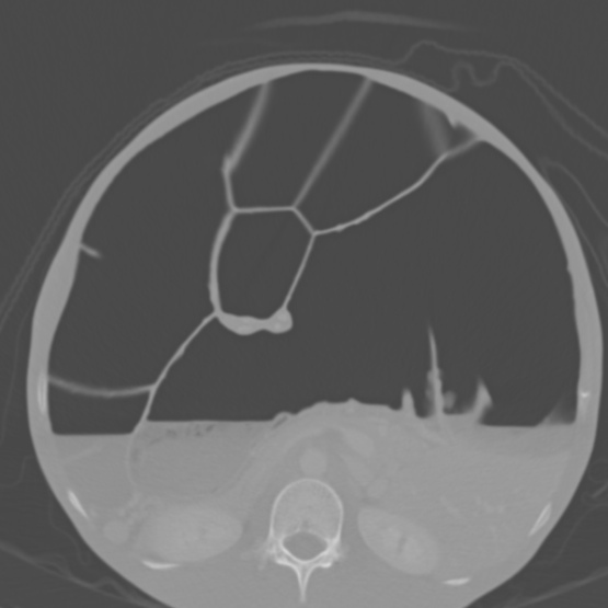 Chronic large bowel pseudo-obstruction (Radiopaedia 43181-46492 Axial bone window 79).jpg