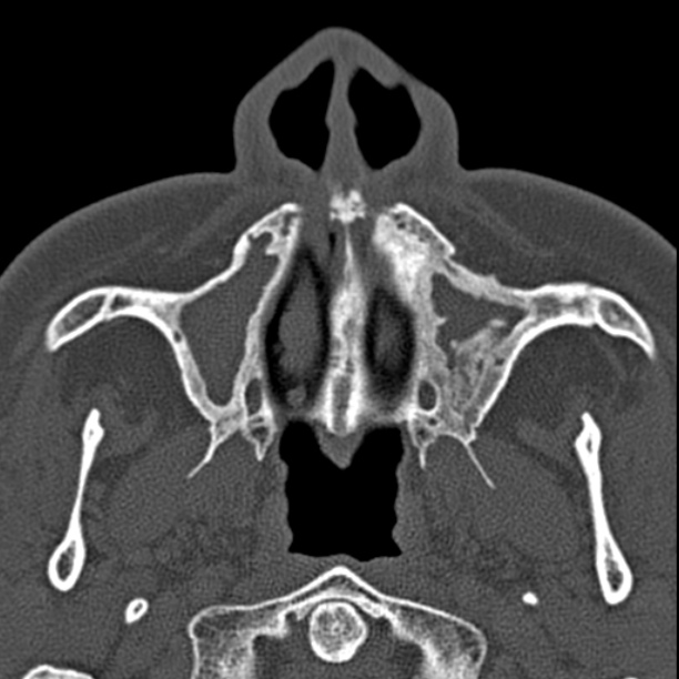 Chronic maxillary sinusitis (Radiopaedia 27879-28116 Axial bone window 9).jpg