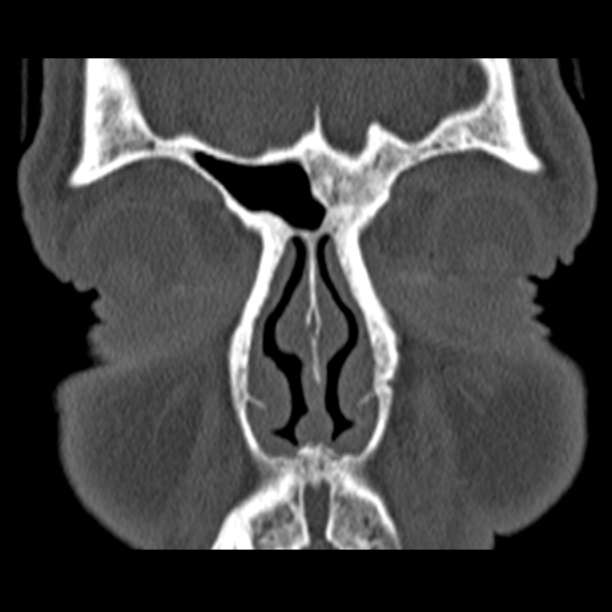 Chronic maxillary sinusitis (Radiopaedia 27879-28116 Coronal bone window 11).jpg
