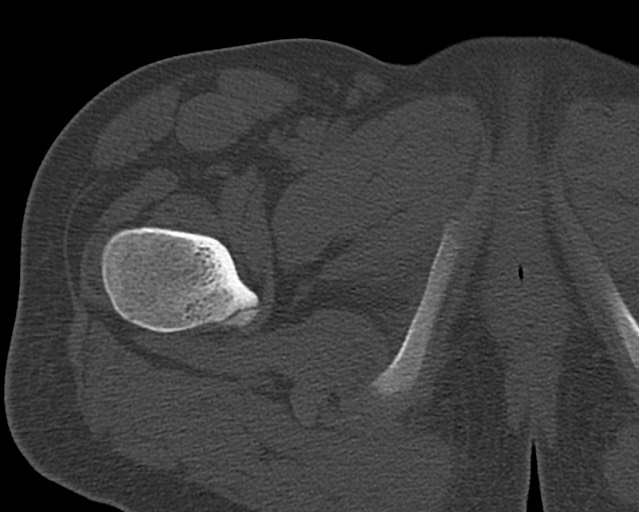 File:Chronic ostemyelitis of the femur with long sinus tract (Radiopaedia 74947-85982 Axial bone window 19).jpg