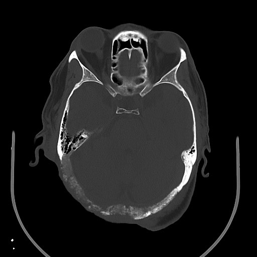 Chronic osteomyelitis - calvarial (severe) (Radiopaedia 69668-79616 Axial bone window 37).jpg