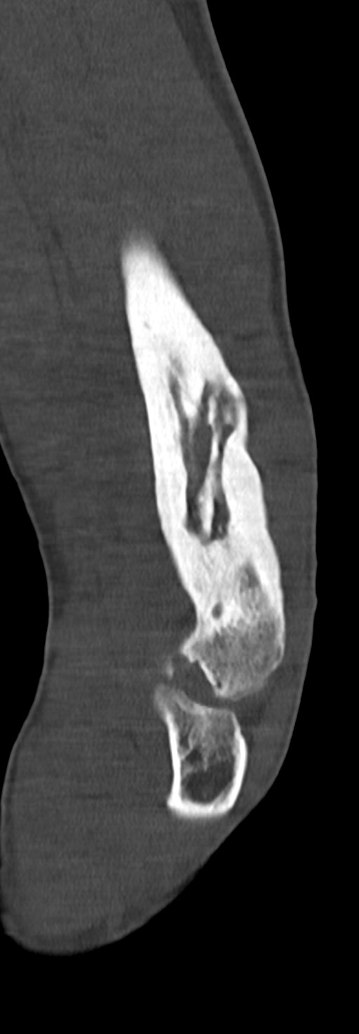 Chronic osteomyelitis of the distal humerus (Radiopaedia 78351-90971 Sagittal bone window 51).jpg