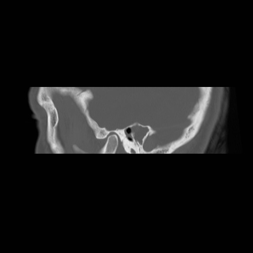 File:Chronic otomastoiditis (Radiopaedia 27138-27309 Sagittal bone window 6).jpg