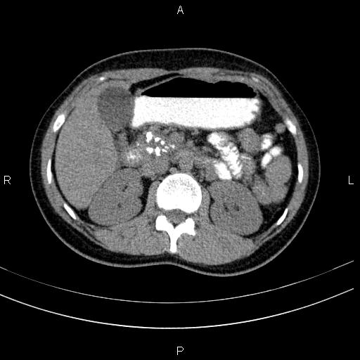 Chronic pancreatitis (Radiopaedia 64576-73450 Axial non-contrast 57).jpg