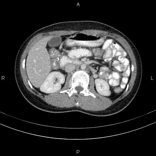 Chronic pancreatitis (Radiopaedia 64576-73450 C 68).jpg