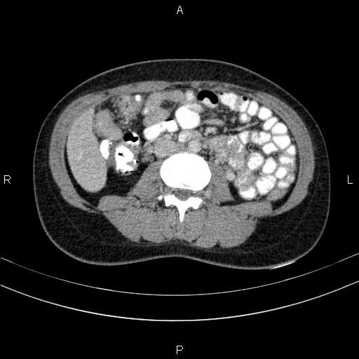File:Chronic pancreatitis (Radiopaedia 64576-73450 C 87).jpg