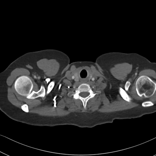Chronic pulmonary embolus (Radiopaedia 39129-41341 Axial C+ CTPA 4).png