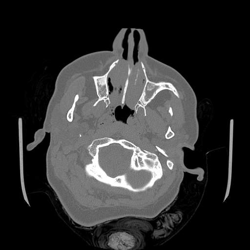 File:Chronic sinusitis with intra-sinus calcification (Radiopaedia 63919-72668 Axial bone window 69).jpg