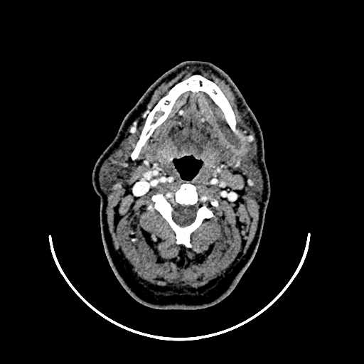File:Chronic submandibular abscess (Radiopaedia 21738-21718 A 18).jpg